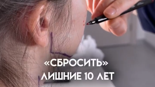 «Сбросить» лишние 10 лет, вернуть коже подтянутый вид, лицу правильность пропорций и четкость контуров позволяет эндоскопическая подтяжка лица.
