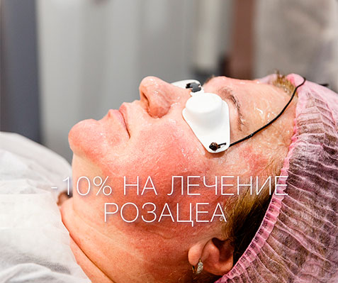 - 10% НА КУРС ЛЕЧЕНИЯ РОЗАЦЕА!