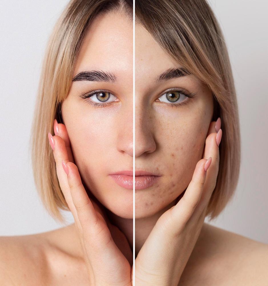 СПРС-терапия