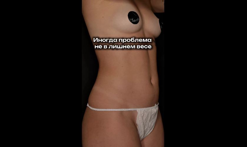 3 недели после липопластики тела. 