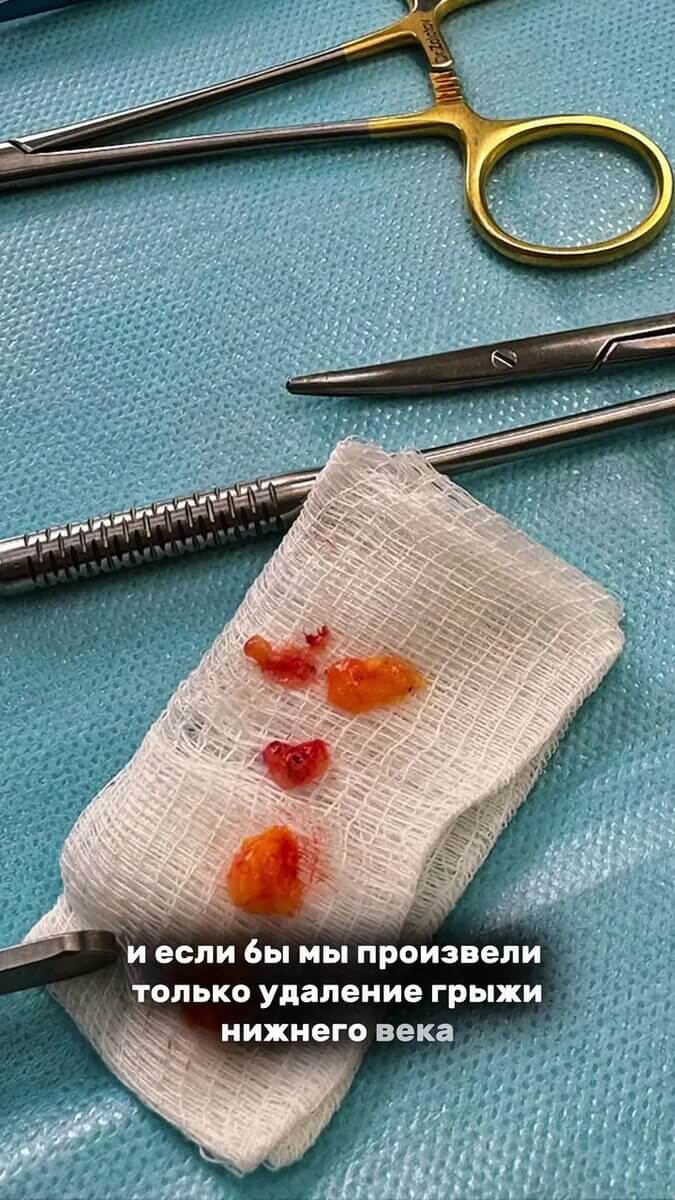 Что избавит от грыж в области нижнего века? Классическая или трансконъюктивальная  блефаропластика?