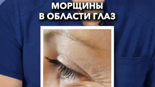 Как убрать морщины в области глаз?