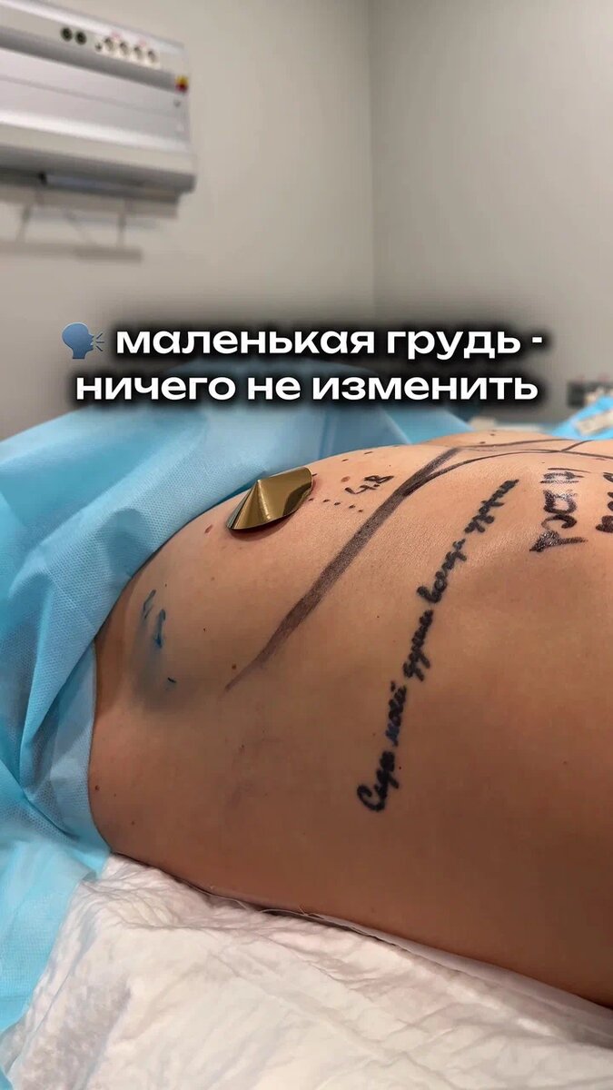 Выполнено бесшовное увеличение груди. 