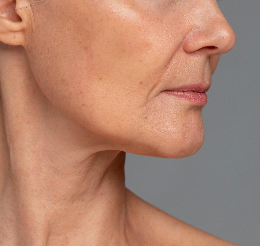 Контурная пластика носогубных складок