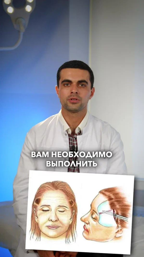 Шон - эндоскопическая подтяжка