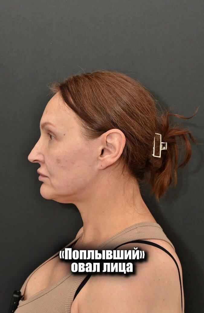 3 месяца после SMAS лифтинга, и трансконъюктивальной блефаропластики нижних век. 