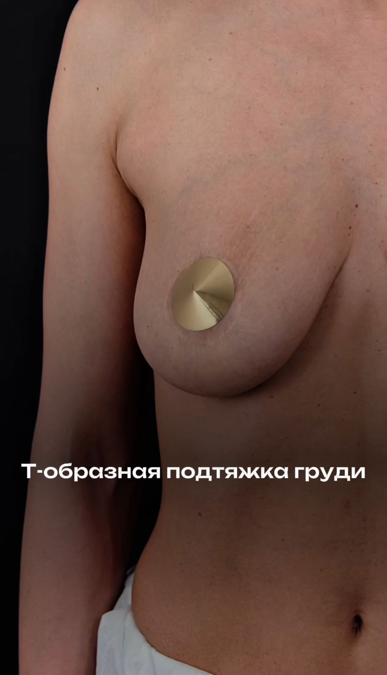 Т-образная подтяжка груди. 