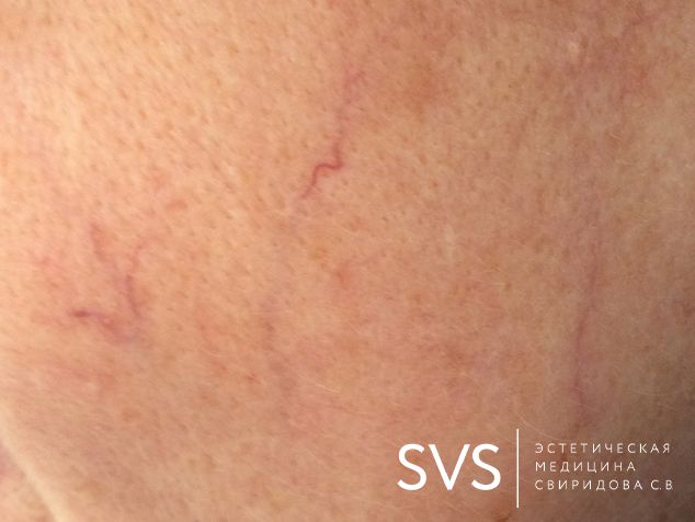 Удаление расширенных сосудов