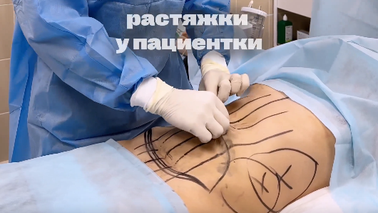 Показания к абдоминопластике - не только большой живот и диастаз.
