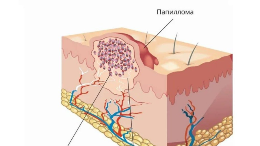 Опасность папиллом - в чём она заключается?