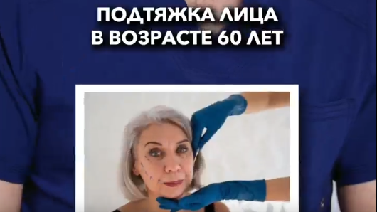 Подтяжка лица в возрасте 60 лет: важность и особенности процедуры