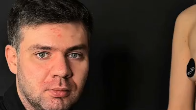 Подбор имплантатов при слабых тканях: кейс на 330 мл