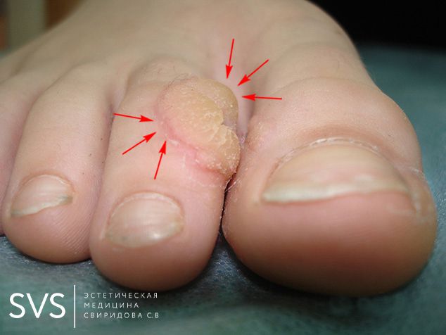 Удаление бородавки