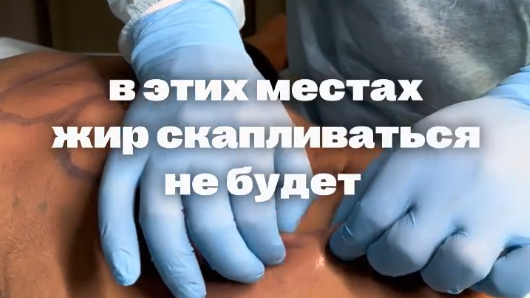 Ультразвуковая бодибилдинг липопластика - это не просто "слепить кубики из жира".
