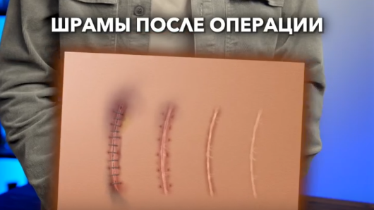 Как избежать шрамы после операции