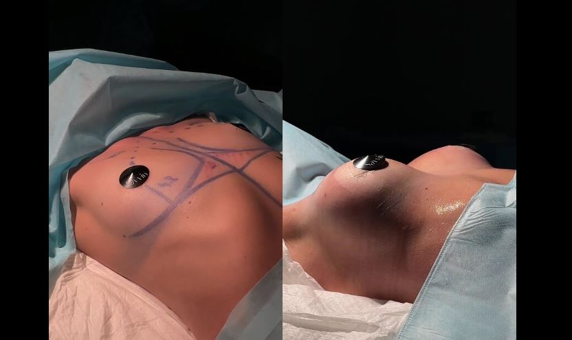 Бесшовное увеличение груди после беременности — результат через 1 месяц