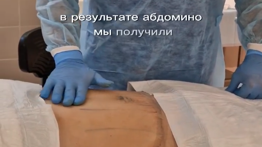 Выполнил пациентке абдоминопластику.