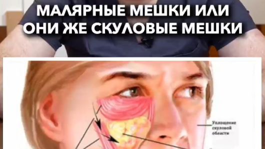 От чего появляются малярные мешки?