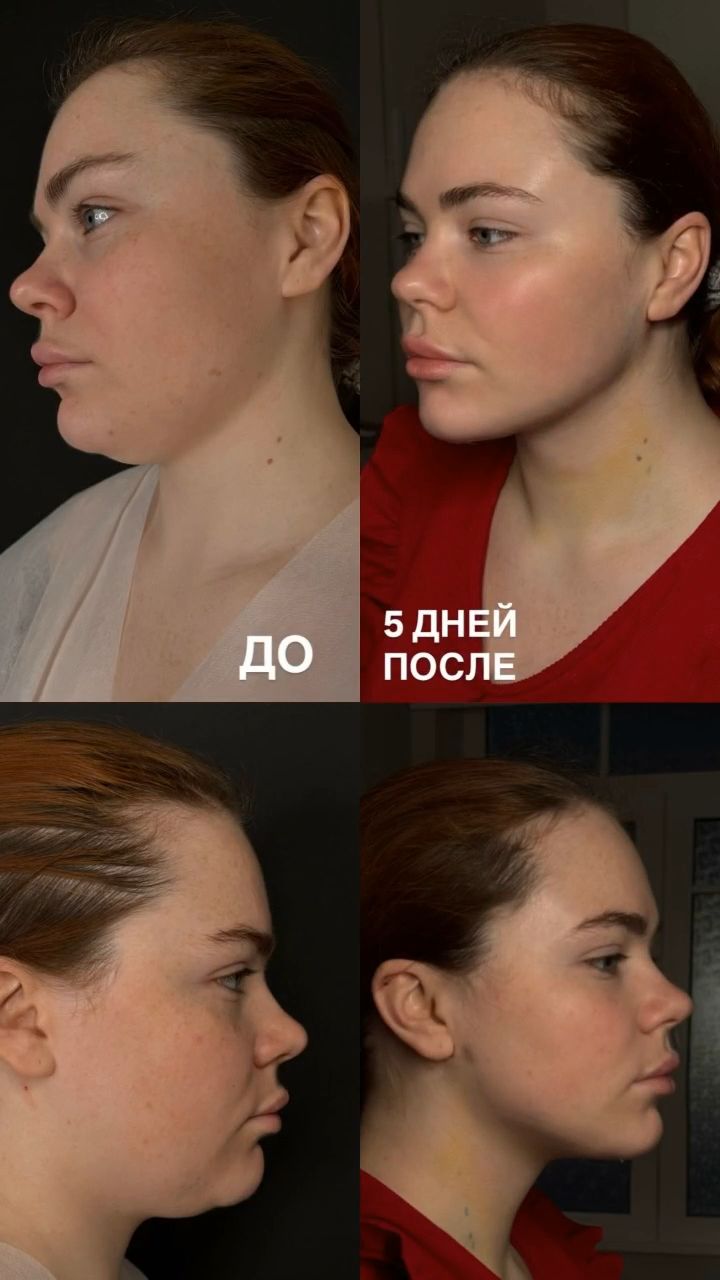Липосакция второго подбородка