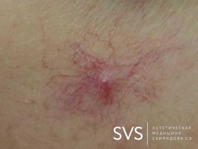 Удаление расширенных сосудов