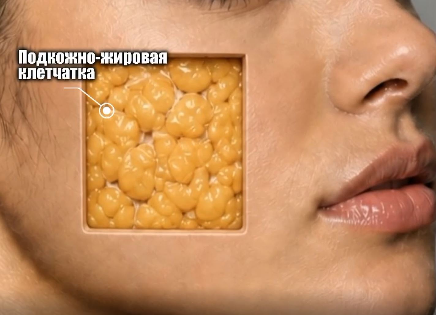 SMAS лифтинг