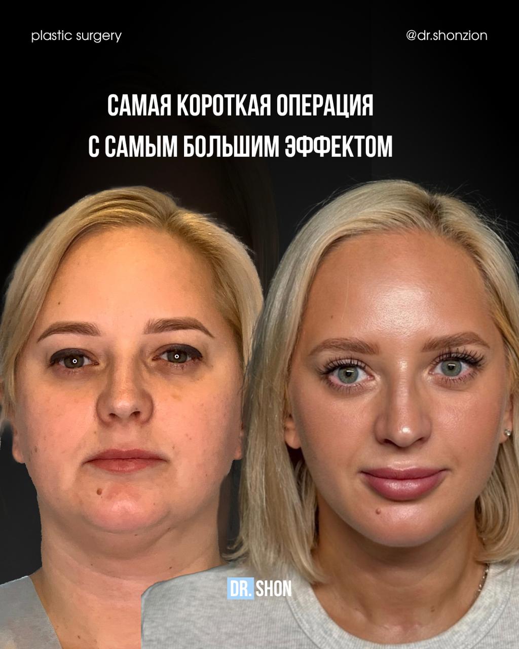 Липосакция подбородка без следов от хирургического вмешательства 
