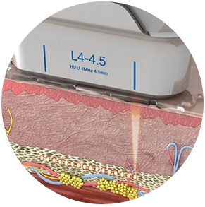 Процедуры ULTRAFORMER