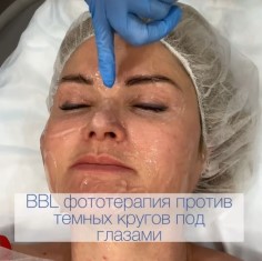 BBL против тёмных кругов под глазами и нависшего века