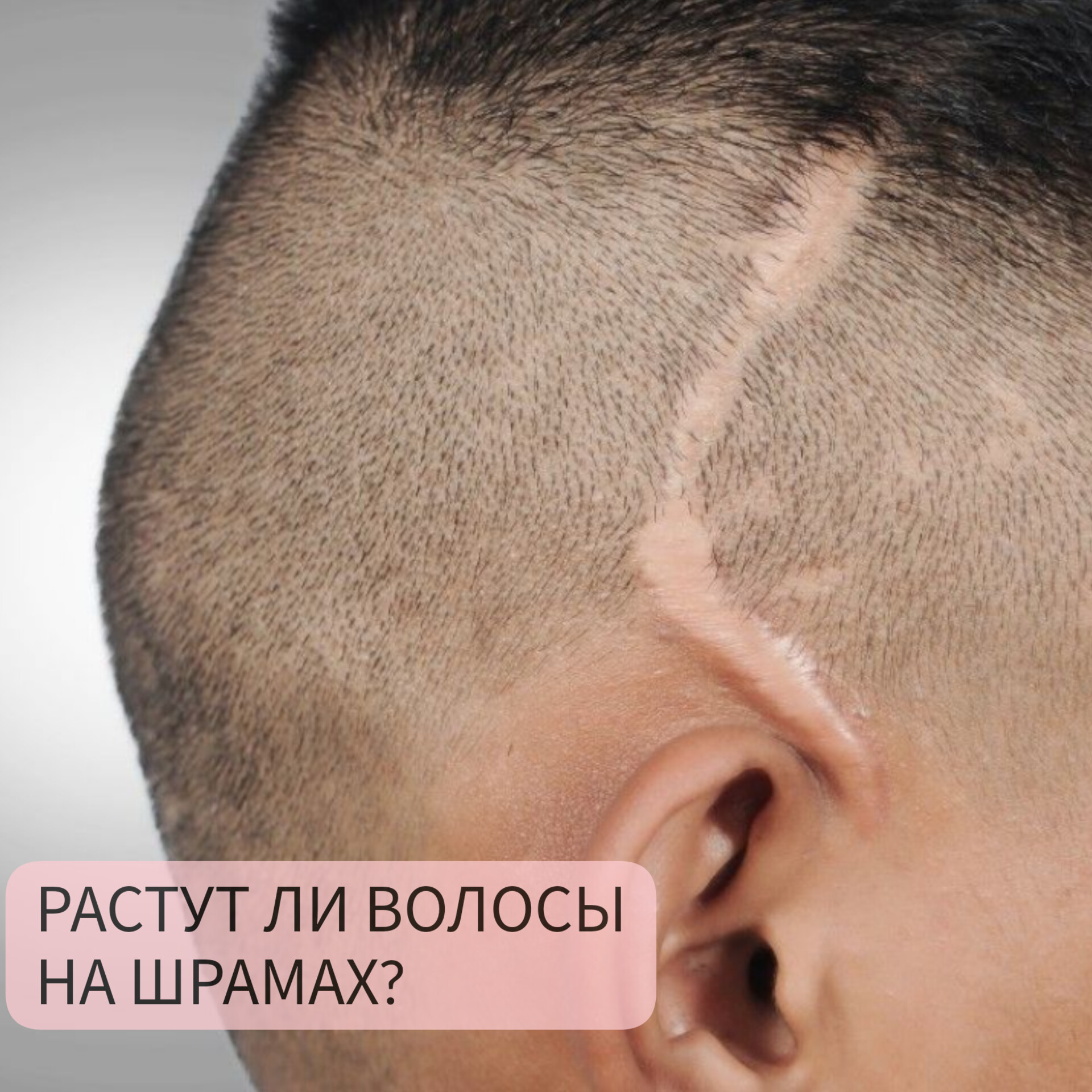 Почему не растут волосы на лице?