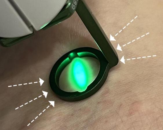 Лечение сосудов лазером Vbeam