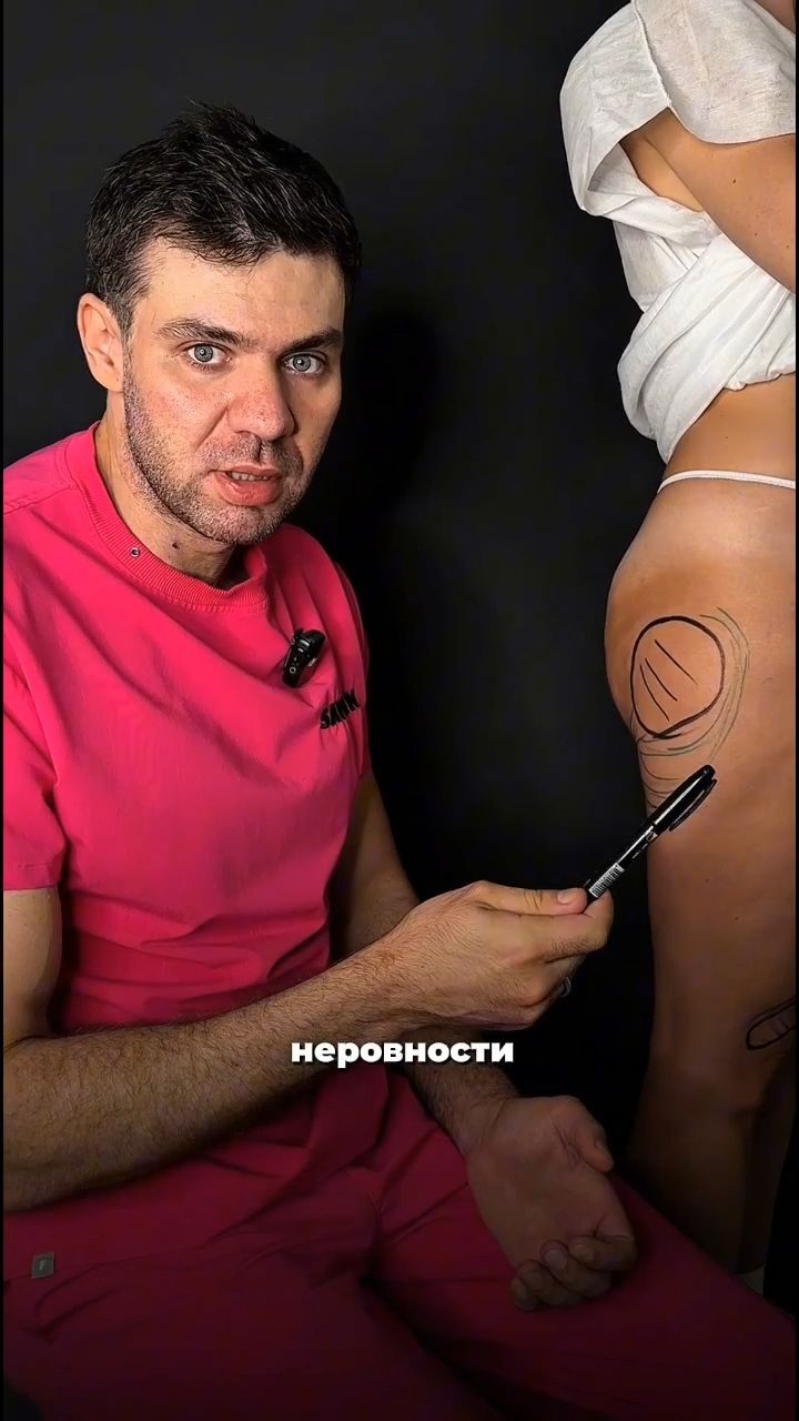 Липосакция бедер — ювелирная работа