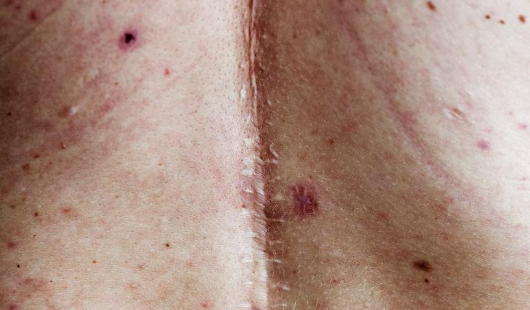 Лечение рубцов и шрамов