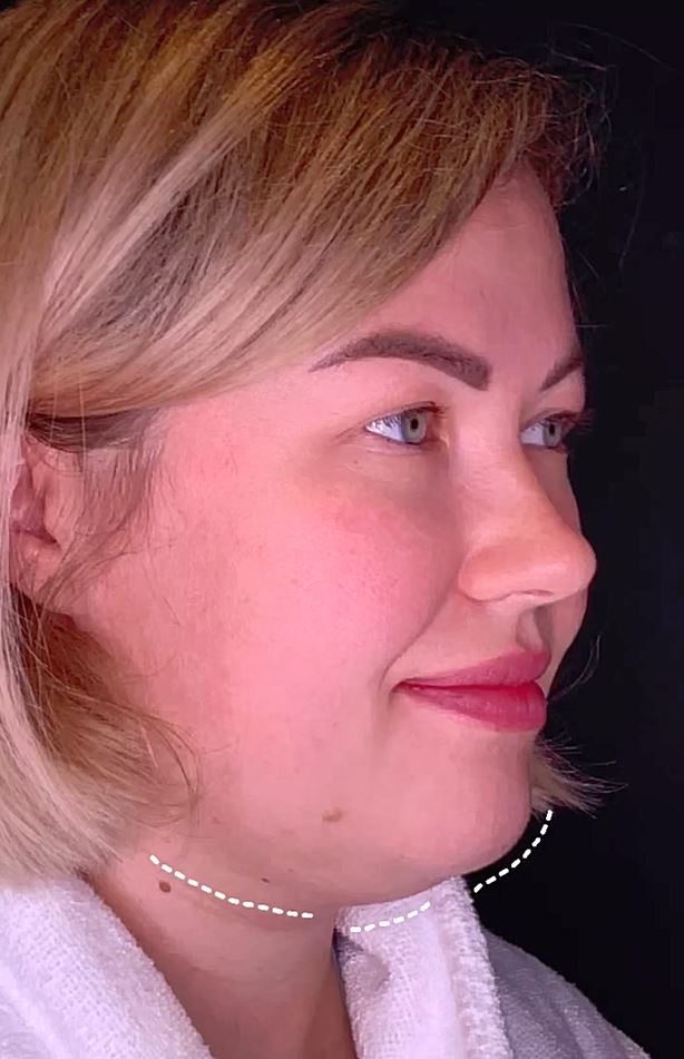 Формирование второго подбородка не зависит от возраста и веса, на него жалуются как полноватые дамы, так и молодые стройные женщины.