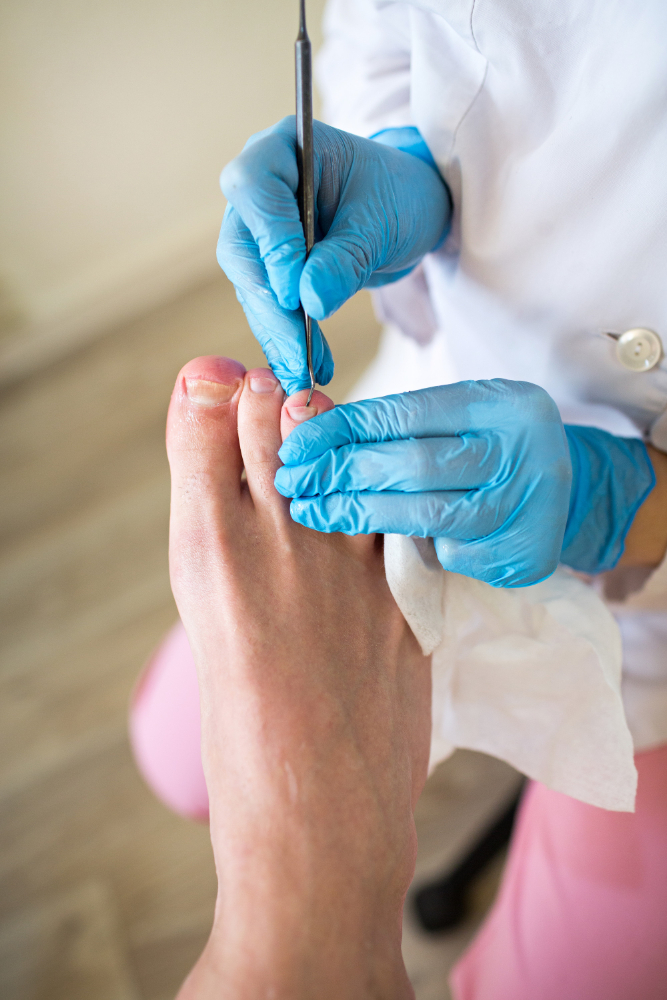 Лечение вросшего ногтя