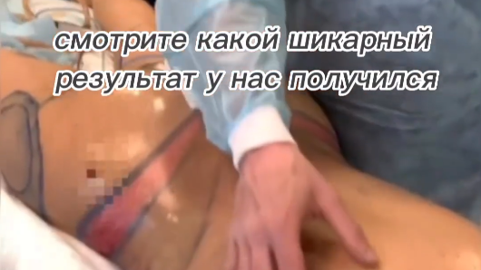 Выполнил липоскульптурирование талии и спины.