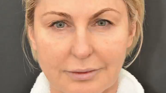 Пациентке выполнена эндоскопическая подтяжка лица. После операции прошло 3 месяца.