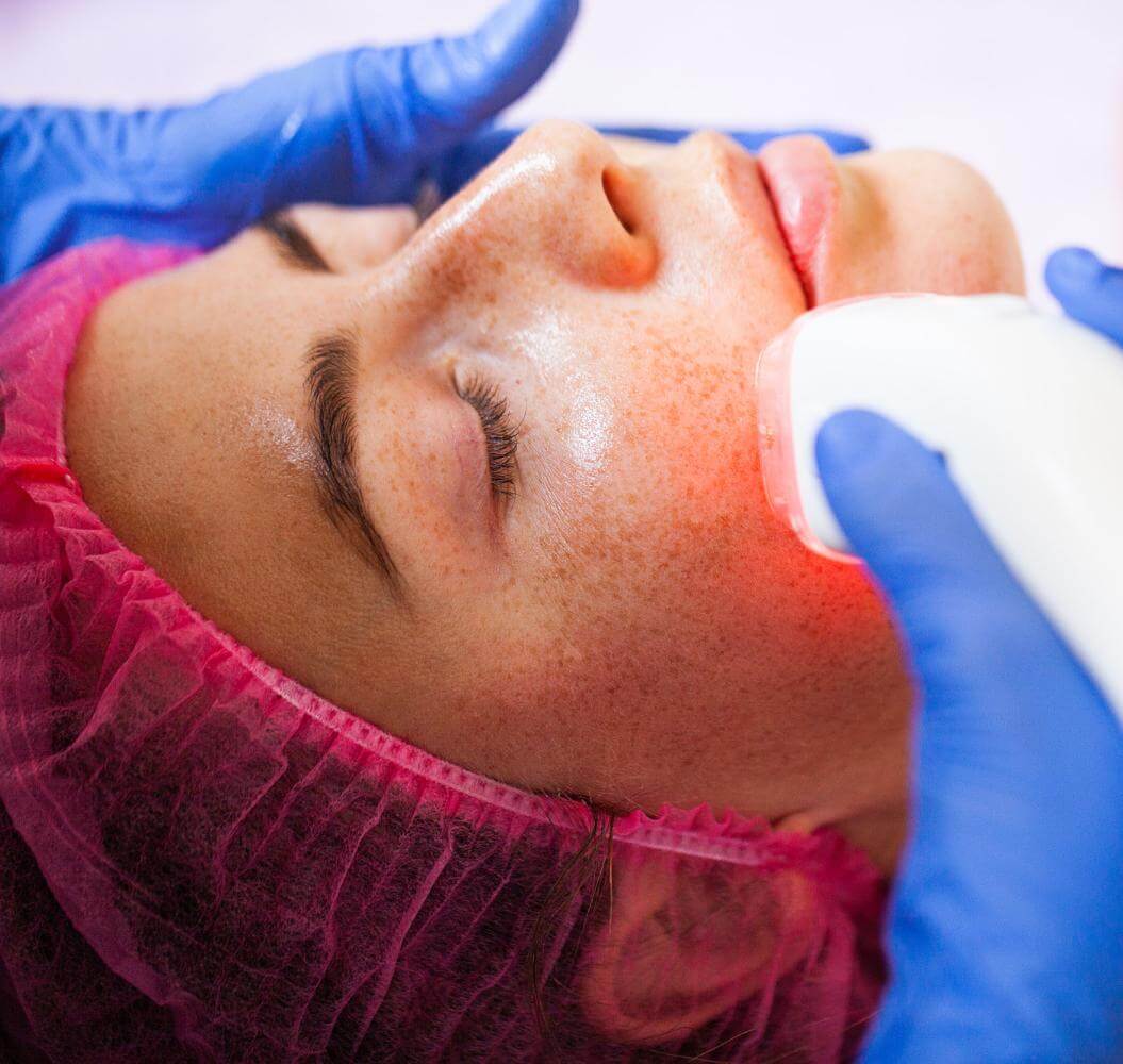 Фототерапия акне