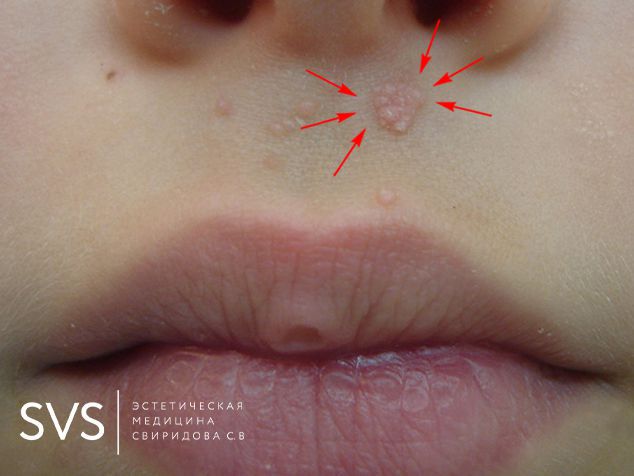 Удаление бородавки