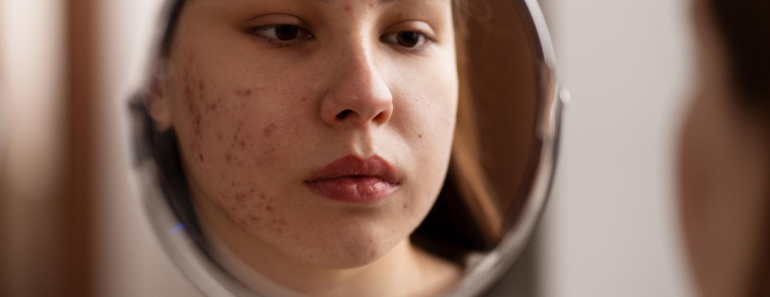 Лечение рубцов