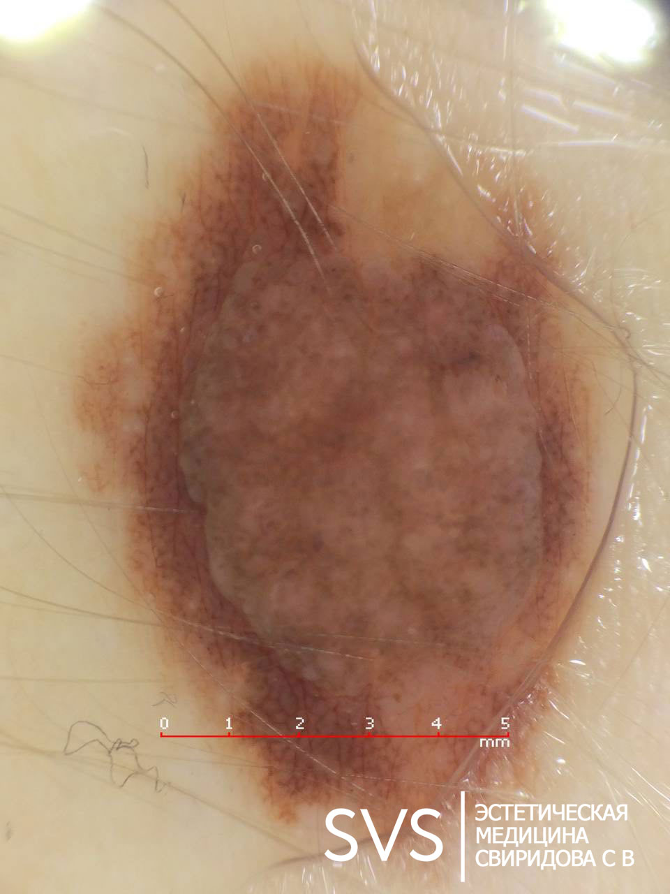 Удаление невуса (родинок)