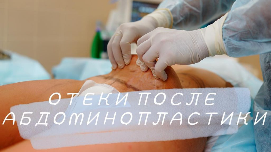 Когда спадают отеки после абдоминопластики?