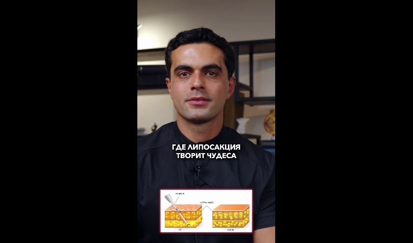 Три зоны где липосакция тварит чудеса