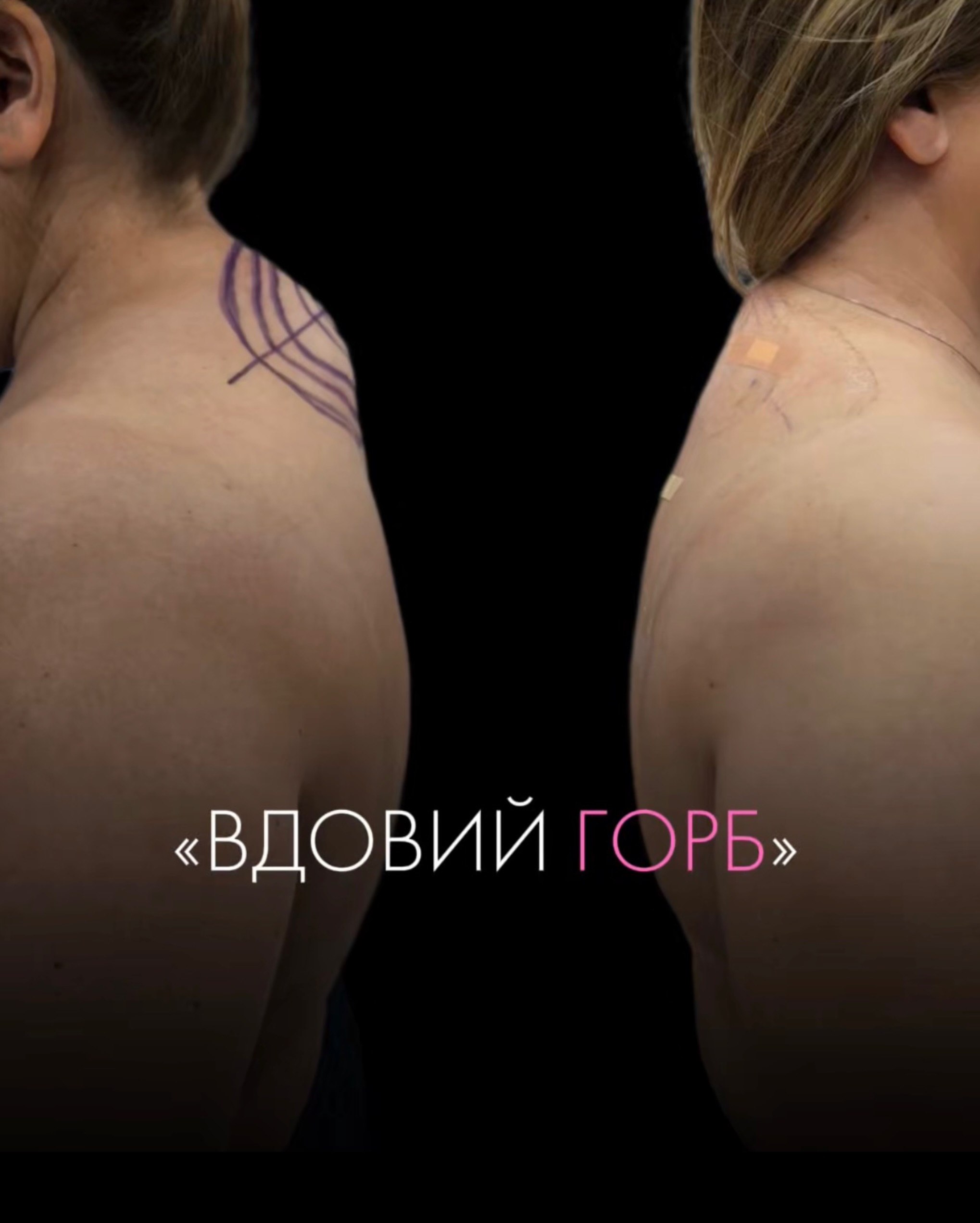Липосакция холки: как убрать «вдовий горбик» и скорректировать контур шеи