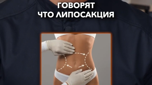 Липосакция для ленивых
