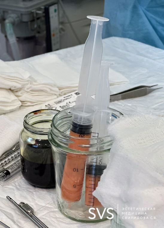 Подготовка к липофилингу одномоментно с липоскульптурированием или липосакцией