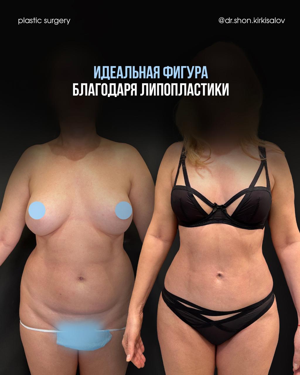 Достижение плоского живота и тонкой талии без стресса для организма