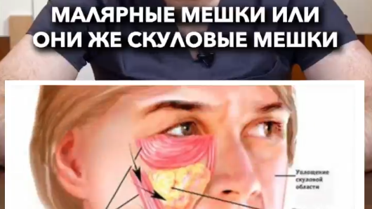Почему появляются малярные мешки?