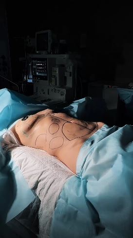 Подтяжка груди без установки имплантатов.