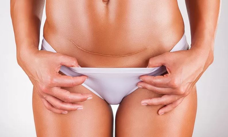 Особая примета: как избавиться от шрамов