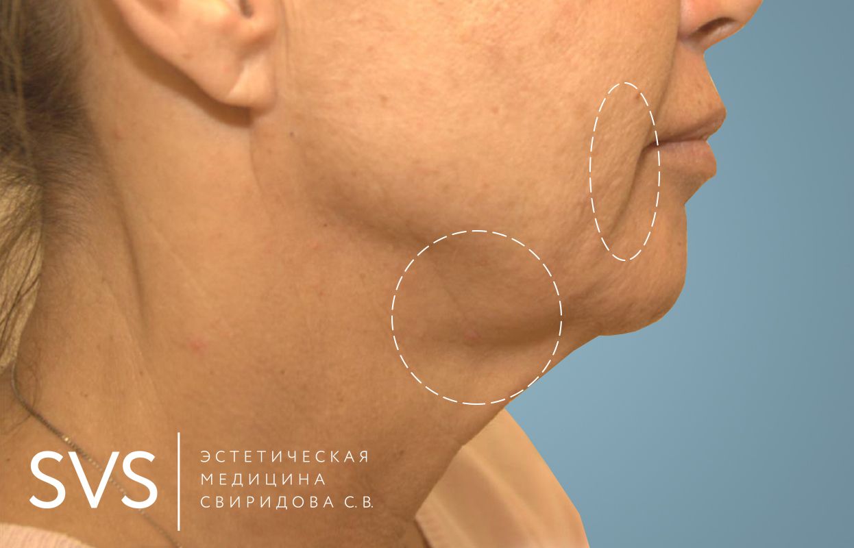 SMAS-ЛИФТИНГ ЛИЦА, ПОДБОРОДКА И ШЕИ